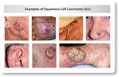 What is an SCC (Squamous Cell Carcinoma)? What is an SCC (Squamous Cell Carcinoma)?